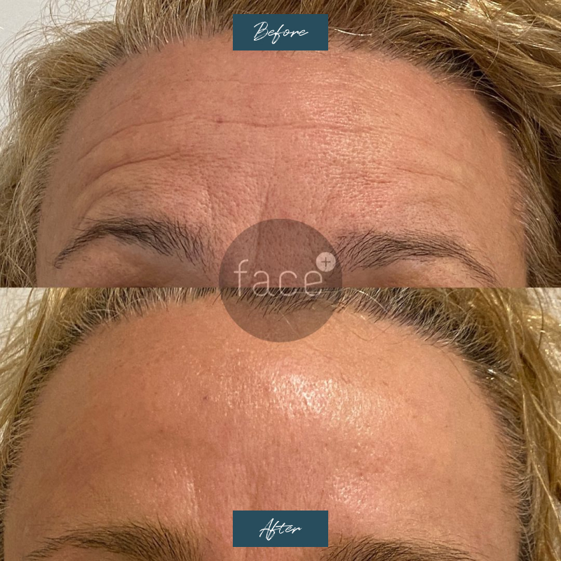 Facial Rejuvenation before after