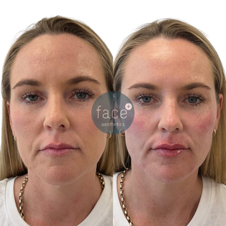 Full face dermal filler rejuvenation – 8 point liquid face lift technique used for this client who was seeking overall, full face rejuvenation