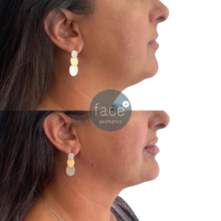Lower face dermal filler – chin, lips and jawline premium dermal filler to balance out the proportions of the face