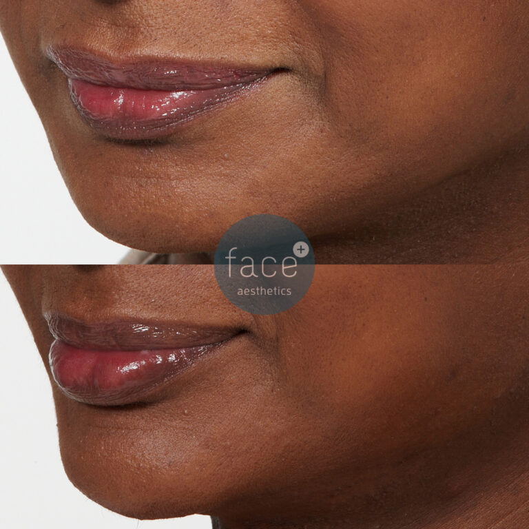Lower face dermal filler – premium dermal filler to the chin and lips to enhance projection and increase symmetry