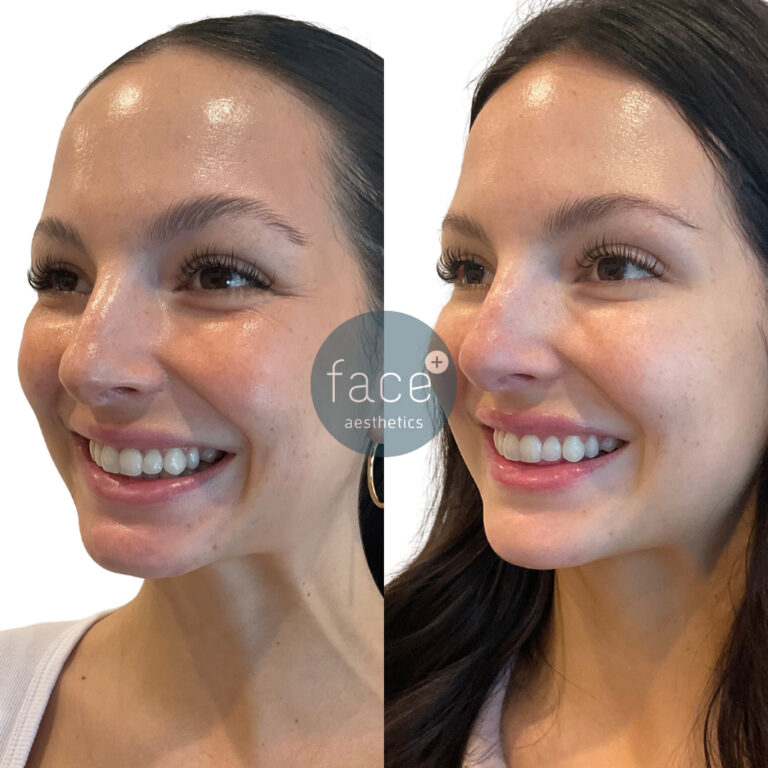 Lower face dermal filler – lip and chin filler to project the side profile and balance out facial features