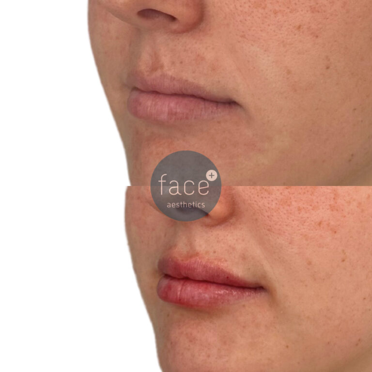 Dermal filler – premium lip filler to hydrate, plump and give added volume, creating a more desirable result.