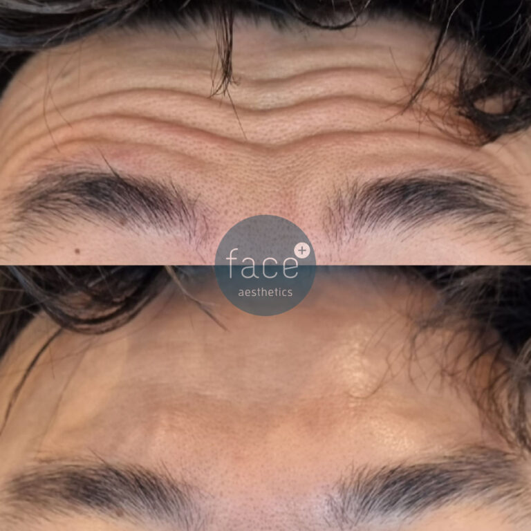 forehead lines treatment