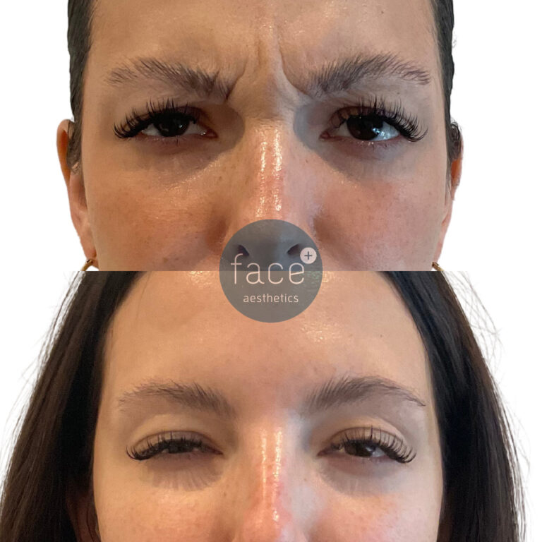 frown lines treatment