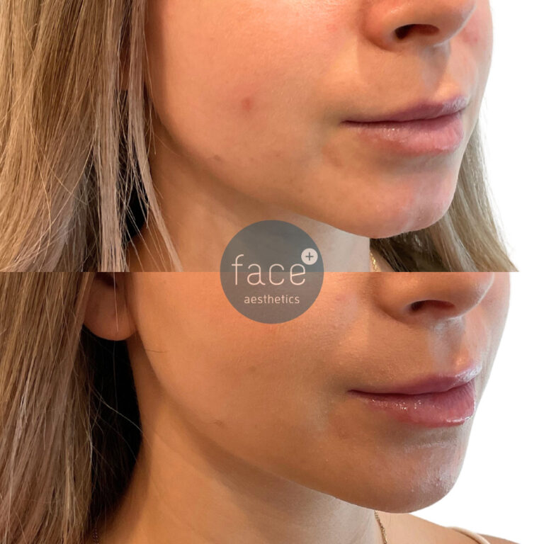 Lower face filler – Chin and jawline filler used to strengthen this lady’s lower face projection and harmonise facial features