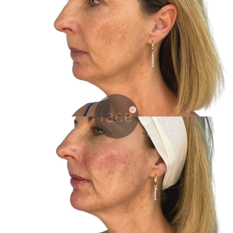 Mid face elevation – Creating a more defined jawline and chin, whilst restoring lost volume to the medial cheeks with our premium dermal filler.